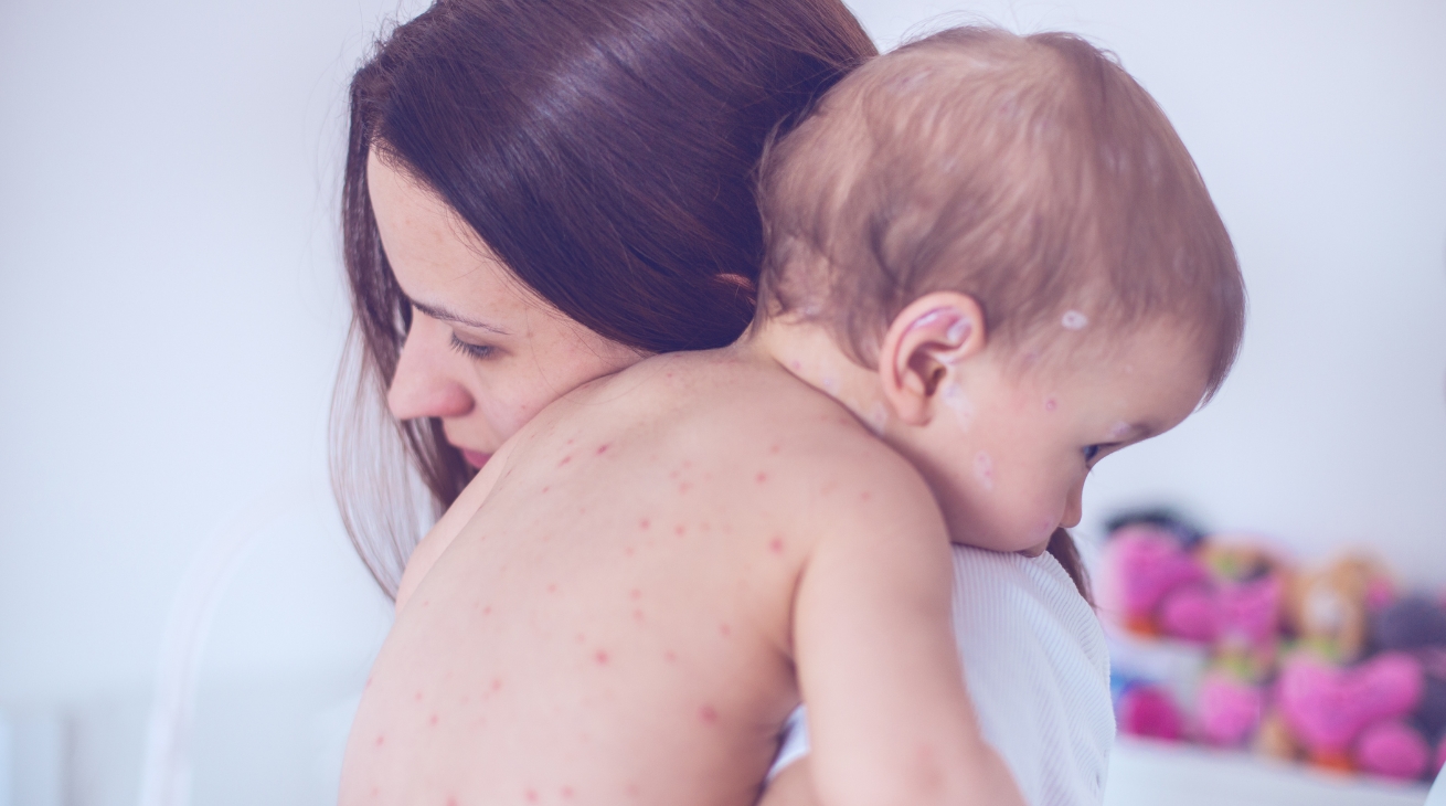 Protecting your family against chickenpox