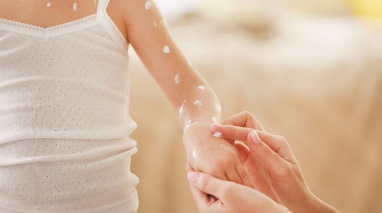Tips for managing chickenpox symptoms