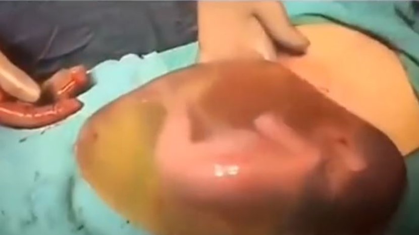 Baby inside amniotic sac
