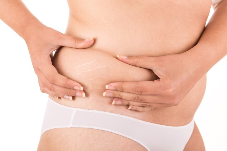 Methods to Help you Reduce the Appearance of Stretch Marks After Pregnancy