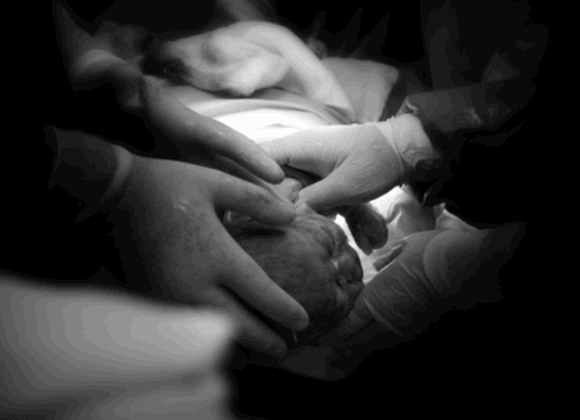 Obstetrician shares the latest news on Caesarean sections